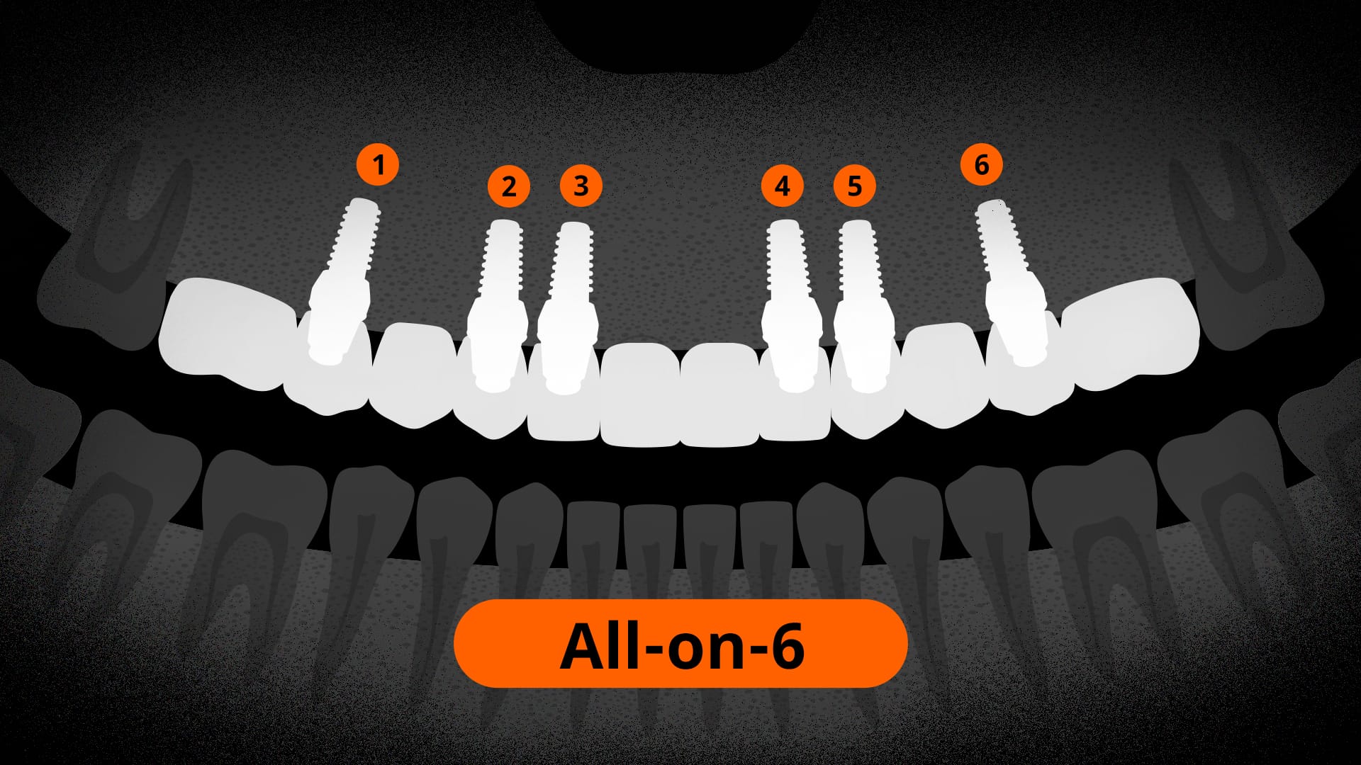 올온식스 식립된 엑스레이 사진 