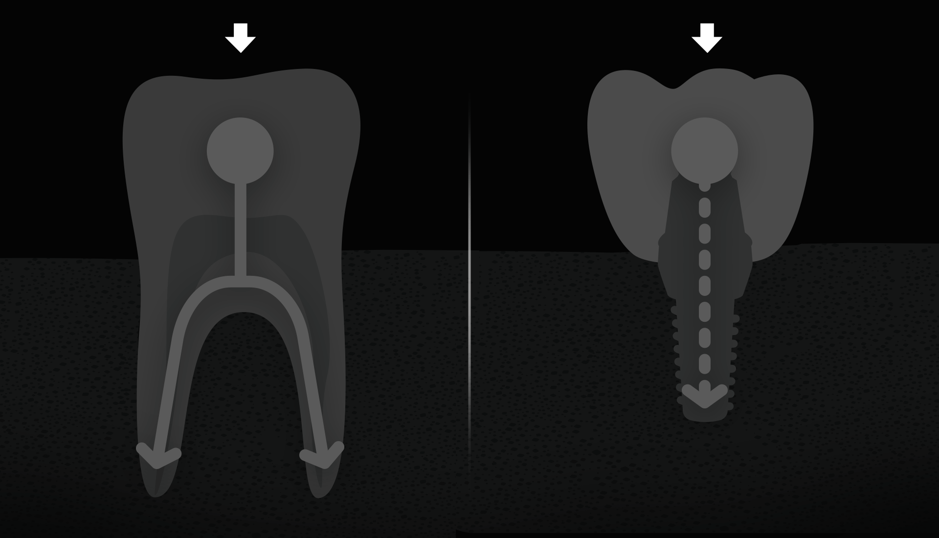 자연치일 때와 임플란트일 때의 어금니의 강도를 비교한 이미지 