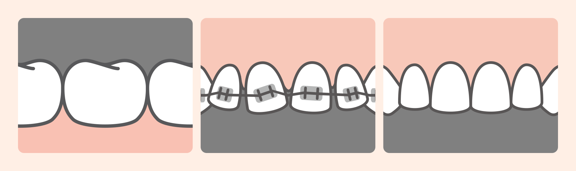 치아 교정 완료 후 환자가 활짝 웃는 미소 뒤에, 재발 방지를 위해 유지장치(리테이너)를 착용하고 있음을 암시하는 일러스트