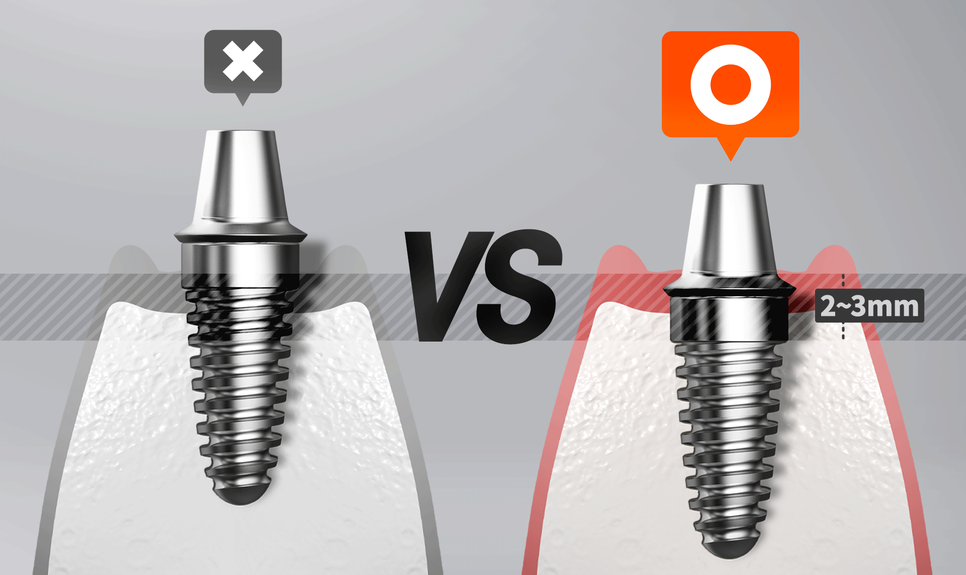임플란트 식립 깊이와 치아 간격 부족으로 인한 잇몸뼈 손실 구조도