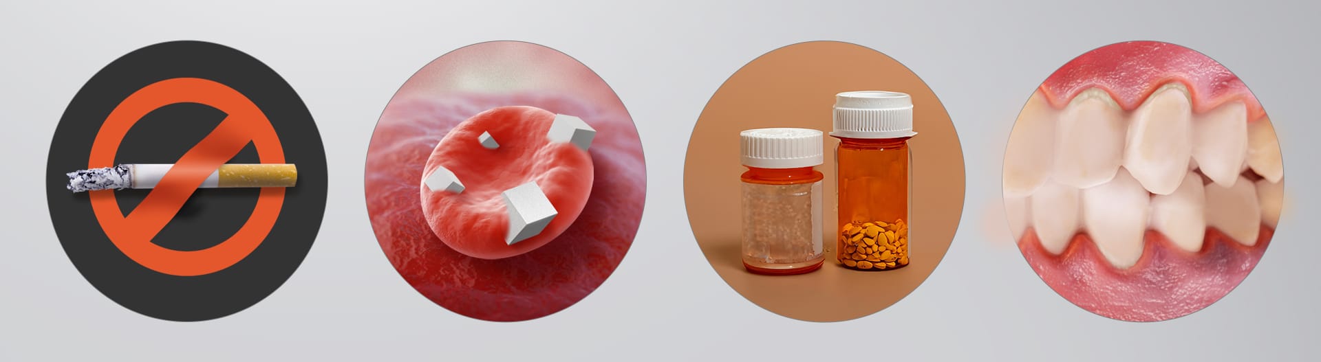 임플란트를 위한 전신 건강 및 습관 일포그래픽