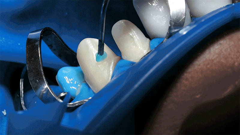 A realistic image showing the bonding process of attaching a laminate veneer to the tooth surface using a strong adhesive