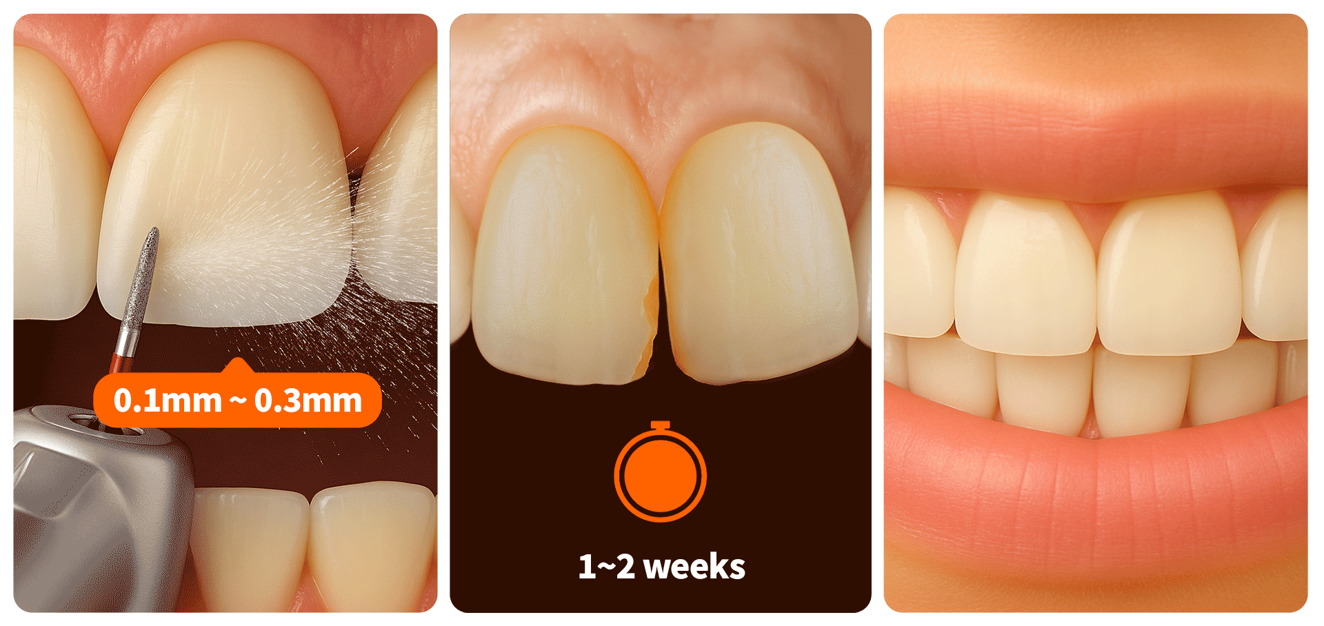 An image expressing the 3 benefits of laminates (minimal reduction, fast results, long-lasting aesthetics) using design elements like 0.1mm–0.3mm figures, a clock, and sparkling teeth