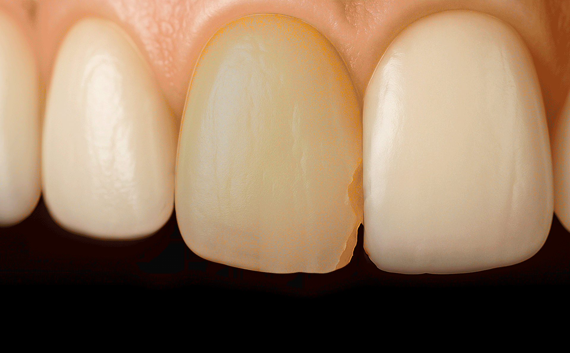 A medical illustration or procedural video showing only a minimal amount of the front tooth surface being prepared (reduced)