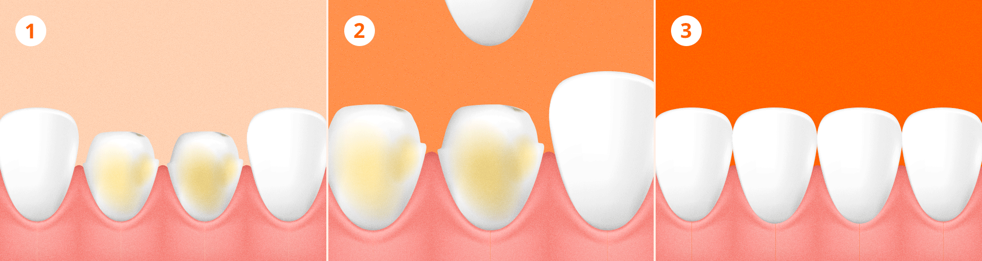 The procedural steps showing the principle of laminate treatment: thinning the tooth surface and bonding a custom-made ceramic veneer (laminate) to change the color and shape