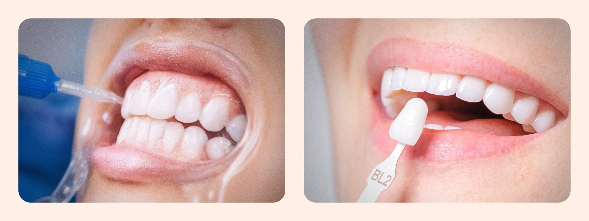 An image side-by-side comparing the procedures of tooth bleaching (applying whitening agent) and laminate treatment (bonding a ceramic veneer)