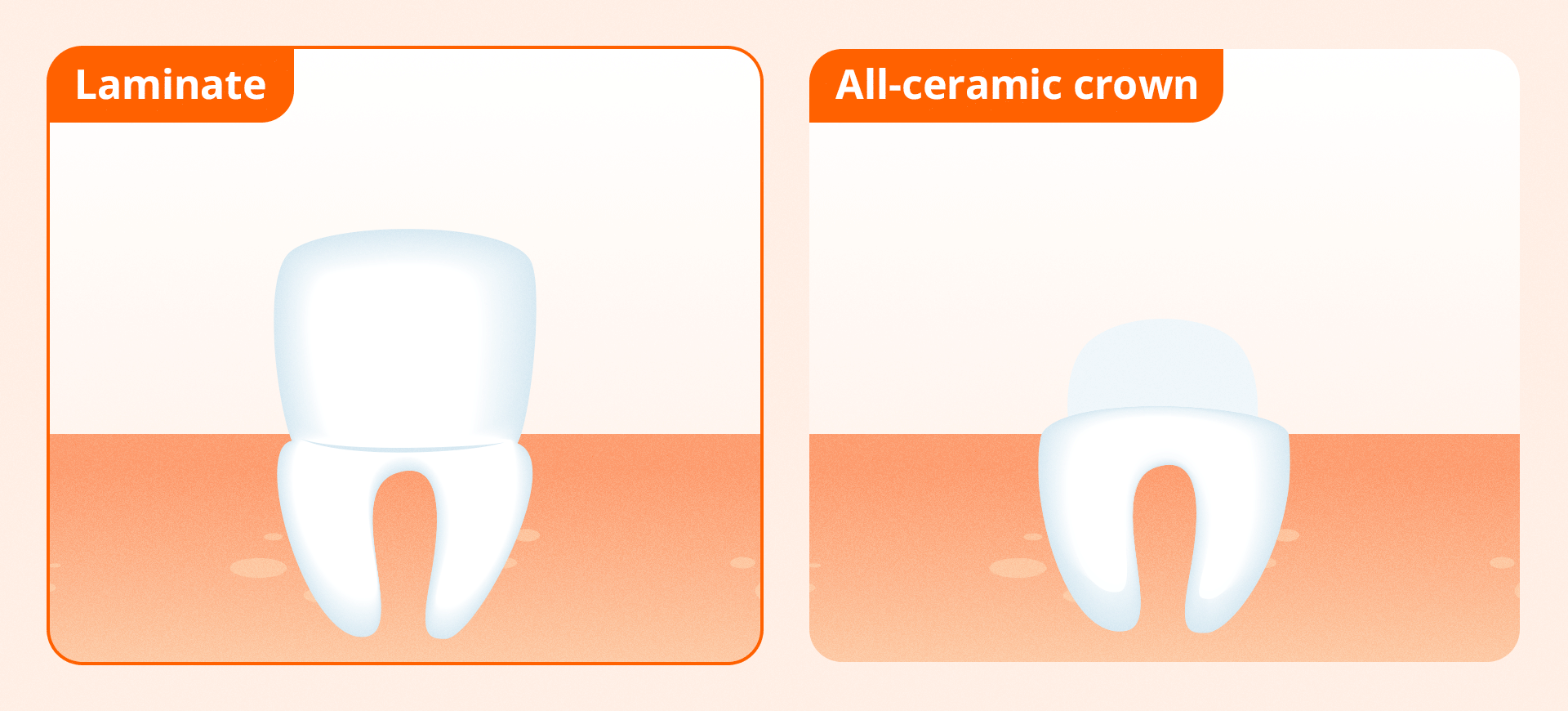 An image comparing the amount of tooth reduction required for laminate veneer and all-ceramic crown procedures
