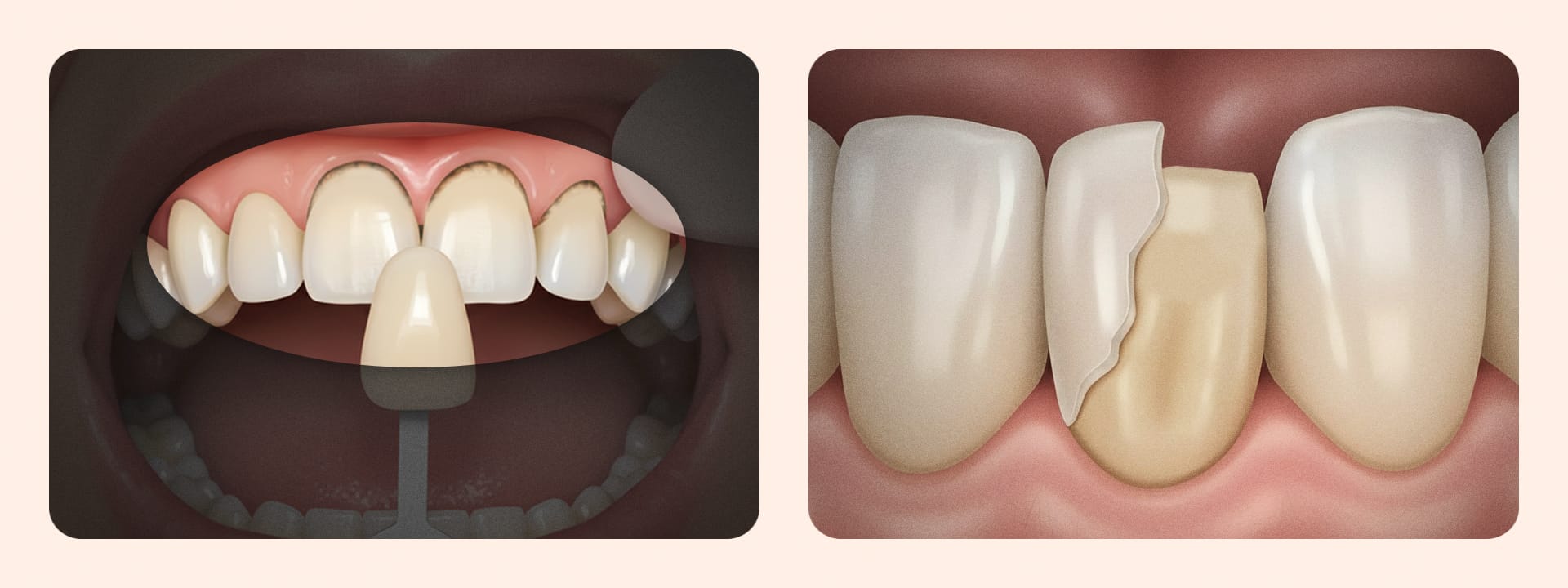 Example damage images showing decay at the adhesive margin between the laminate and natural tooth, or fracture of the laminate veneer tip