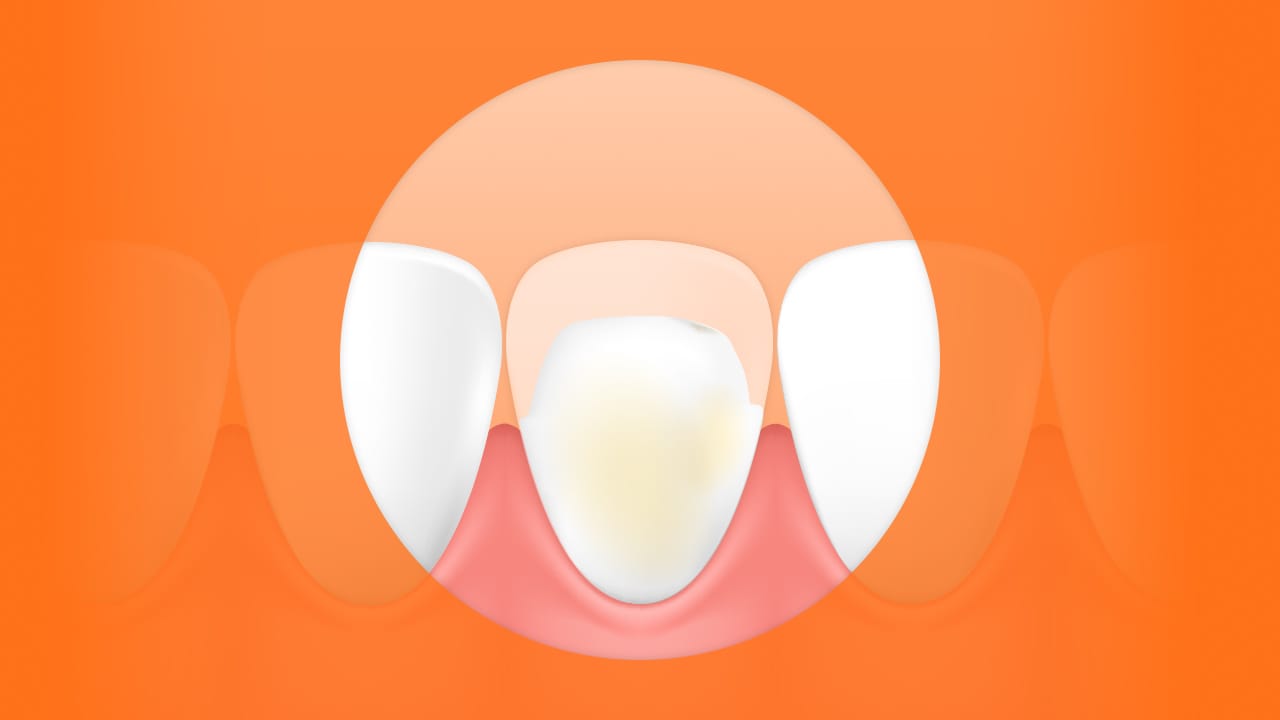 ラミネートベニアの価格表より先に確認すべき5つのポイント