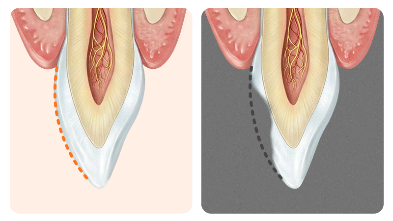 A simplified illustration of a tooth cross-section highlighting the thickness of the outer enamel layer