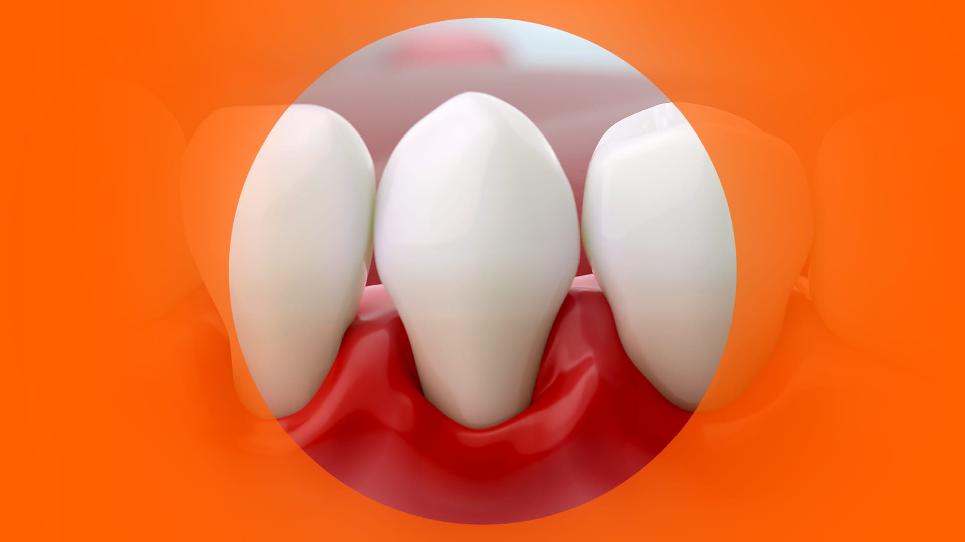 Peri-Implantitis Warning Signs: A Practical Self-Check and Treatment Guide