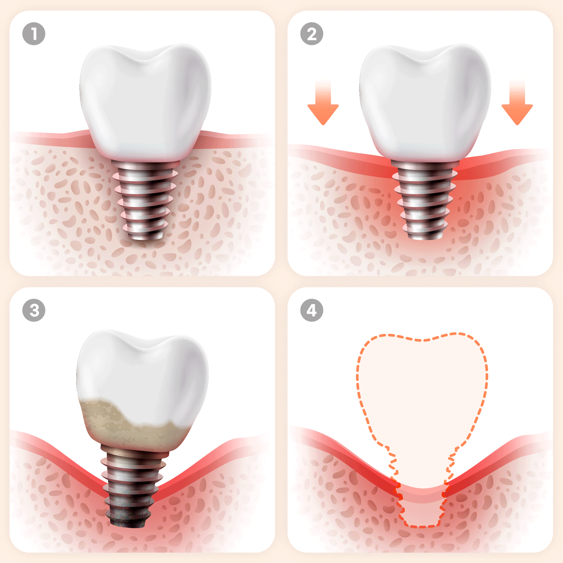 방치하면 벌어지는 치명적인 결과를 4단계로 표현한 이미지 