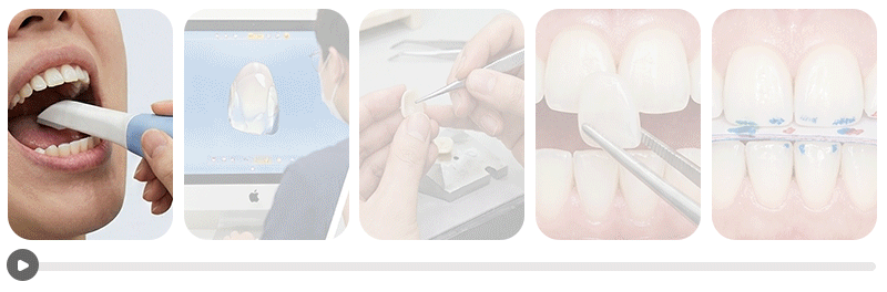 Infographic showing the standard dental veneer procedure from precision diagnosis and fabrication to final bonding and bite adjustment.