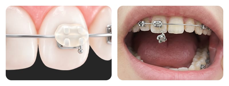An image of orthodontic relief wax being applied to a detached or broken orthodontic bracket to prevent irritation.