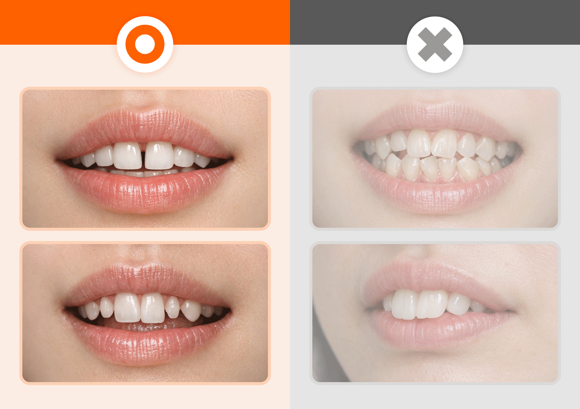 Infographic comparing suitable and unsuitable teeth for laminate veneer procedures.