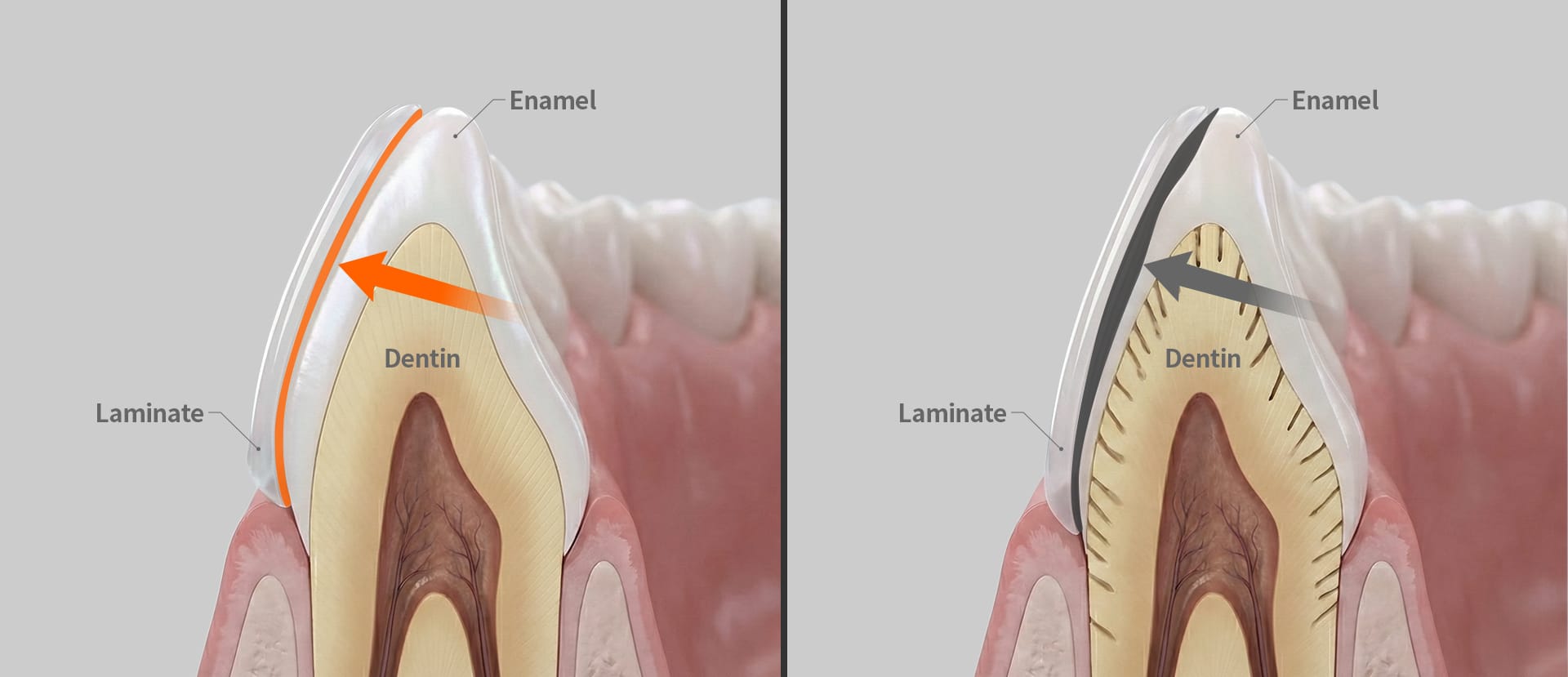 Tooth cross-section showing strong adhesion when bonding veneers to enamel.