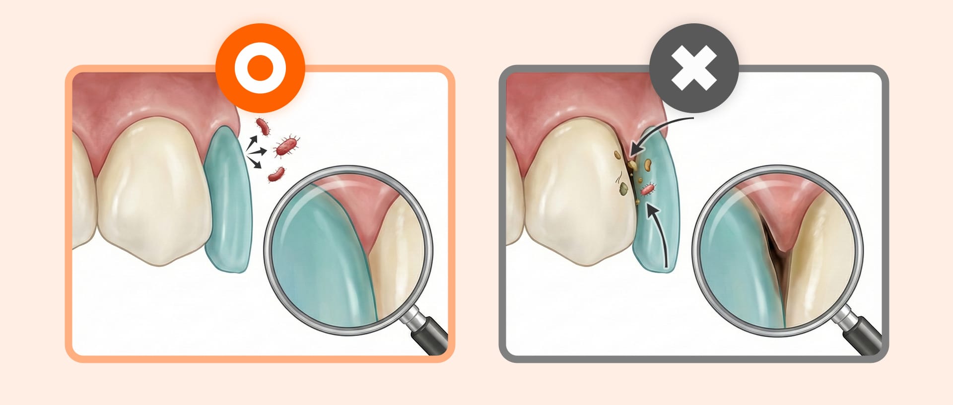 Magnified comparison of smooth vs. gapped veneer margins and secondary cavity risk.