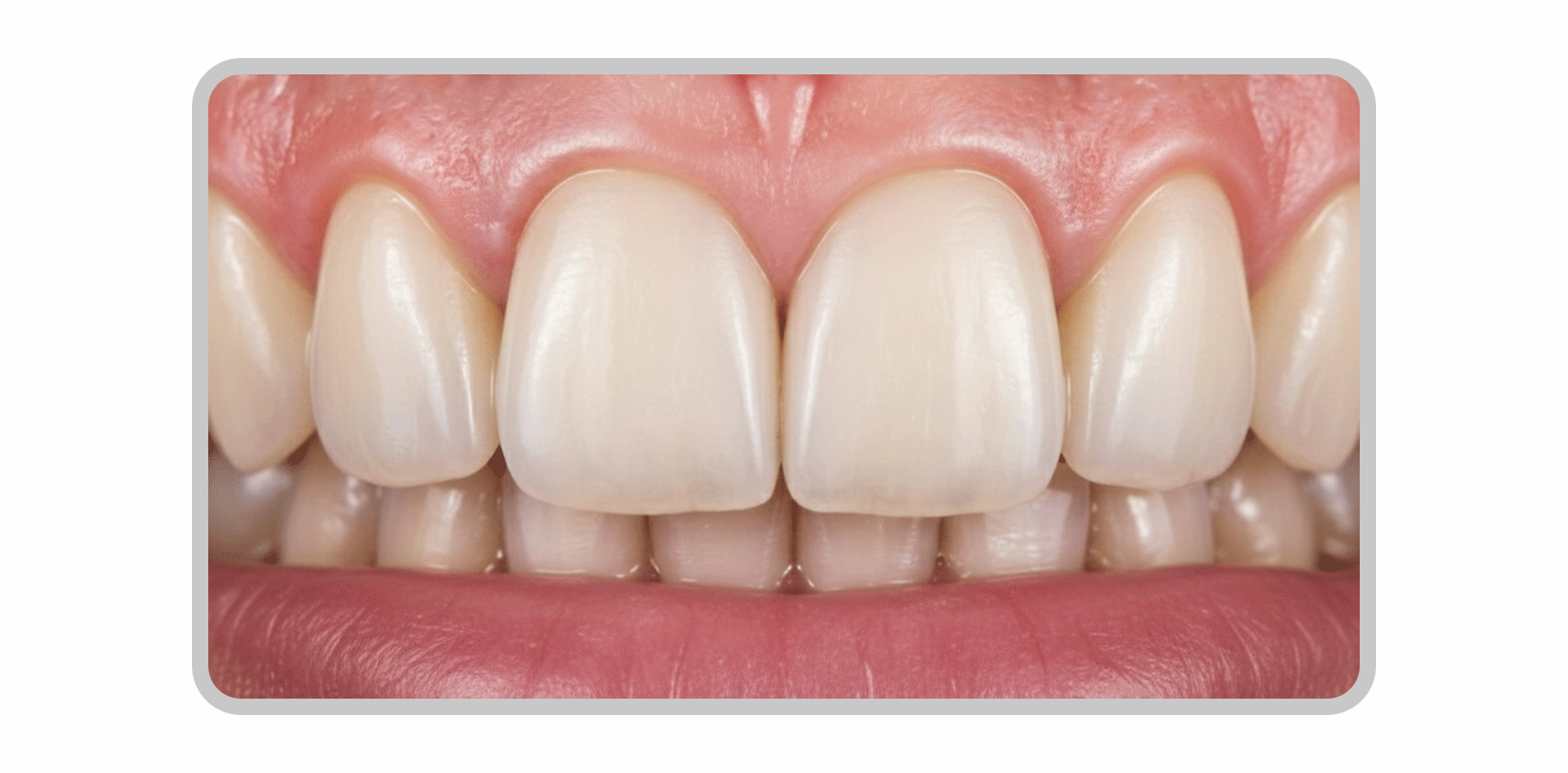 A magnified image showing marginal discoloration, which is a dark band forming gradually along the gum line of the veneer.