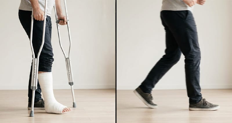 A medical cast vs. walking freely, representing the temporary recovery process.