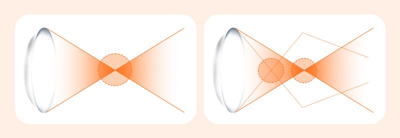 A diagram comparing the functional differences between monofocal and multifocal intraocular lenses.