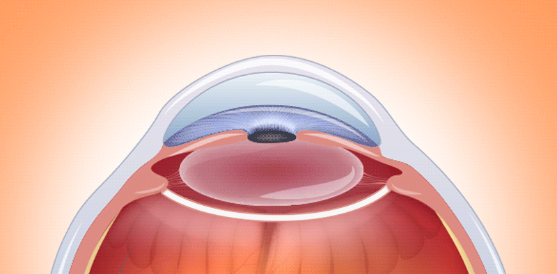 A visualization of laser treatment for posterior capsular opacification (PCO) following cataract surgery
