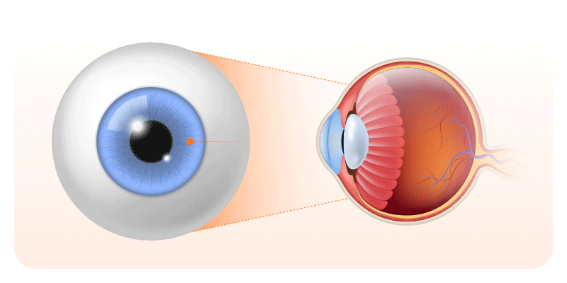A visual illustration of the risks and potential complications of hypermature cataracts