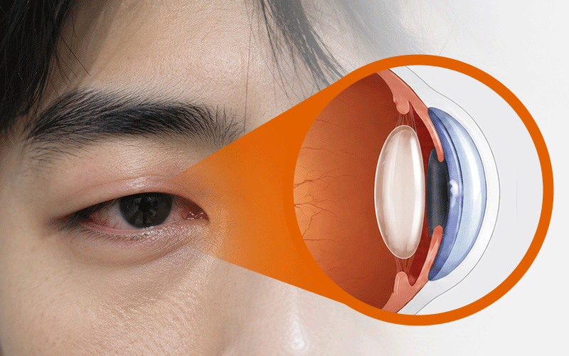 A visual illustration showing the potential development of a traumatic cataract after a physical impact to the eye
