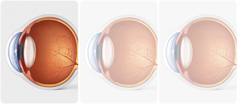 An infographic showing three conditions that can occur after eye trauma: hyphema, retinal detachment, and lens dislocation