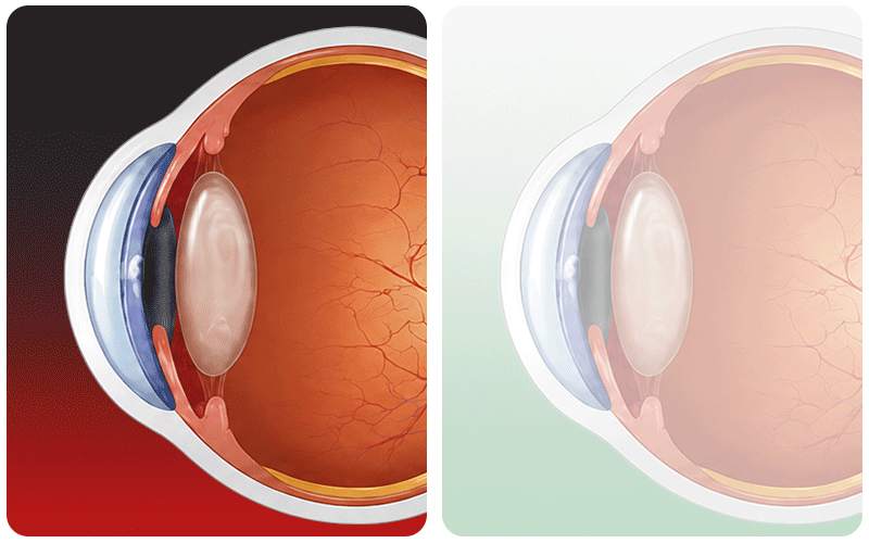 An infographic comparing scenarios that require early surgery versus cases where monitoring and observation are sufficient for a traumatic cataract