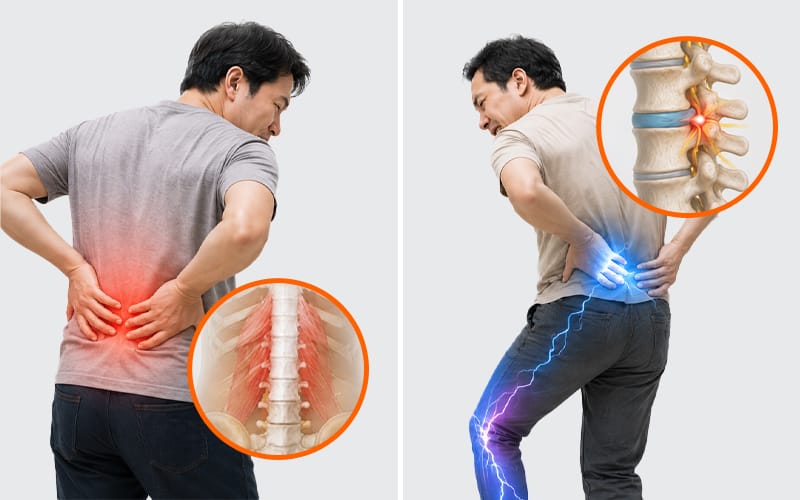 An illustration comparing a herniated disc and a lumbar sprain.