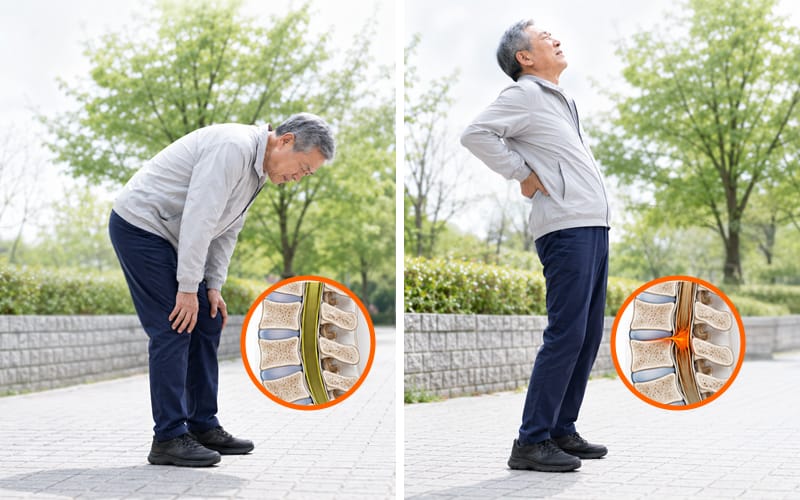An illustration comparing spinal canal width when bending and straightening the back