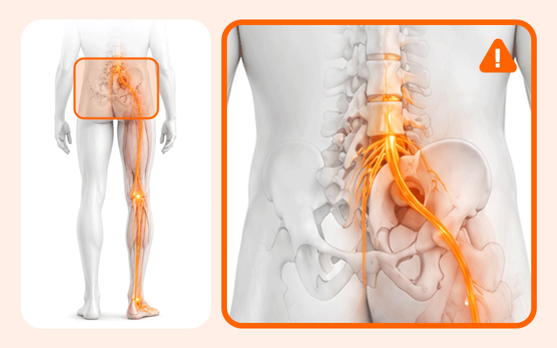 An illustration of pain radiating from the cauda equina to the sciatic nerve