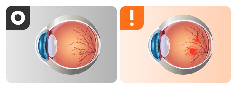 An illustration comparing a normal retina with diabetic retinopathy