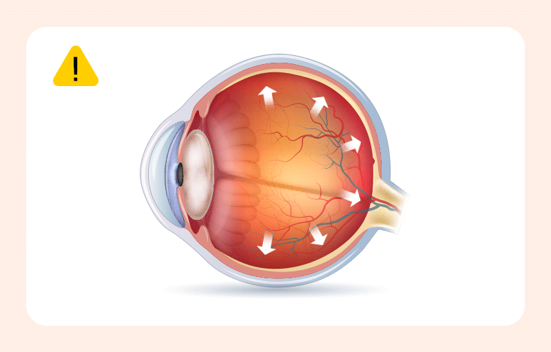A cross-sectional illustration of an eye showing increased intraocular pressure (IOP)