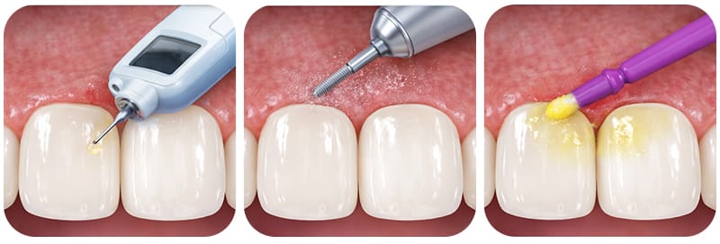 A magnified view of Immediate Dentin Sealing (IDS) technology coating the prepped tooth surface