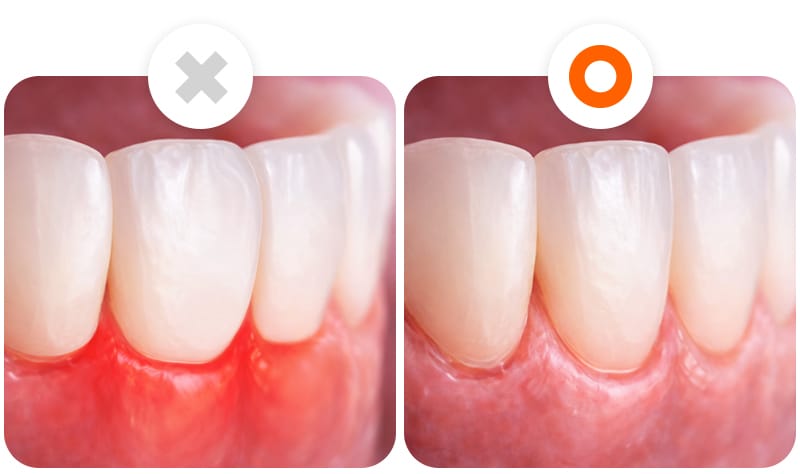 An illustration showing that minimal-prep veneers can sometimes be better than no-prep veneers