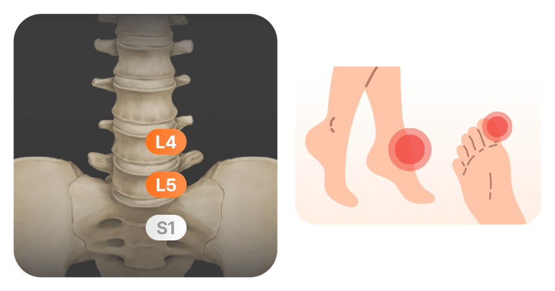An infographic showing nerve root irritation sites based on toe pain location