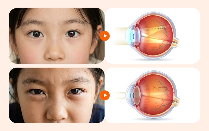 A child squinting and rubbing their eyes at an eye clinic with worried parentsAn illustration comparing refractive error (astigmatism) with the pinhole effect