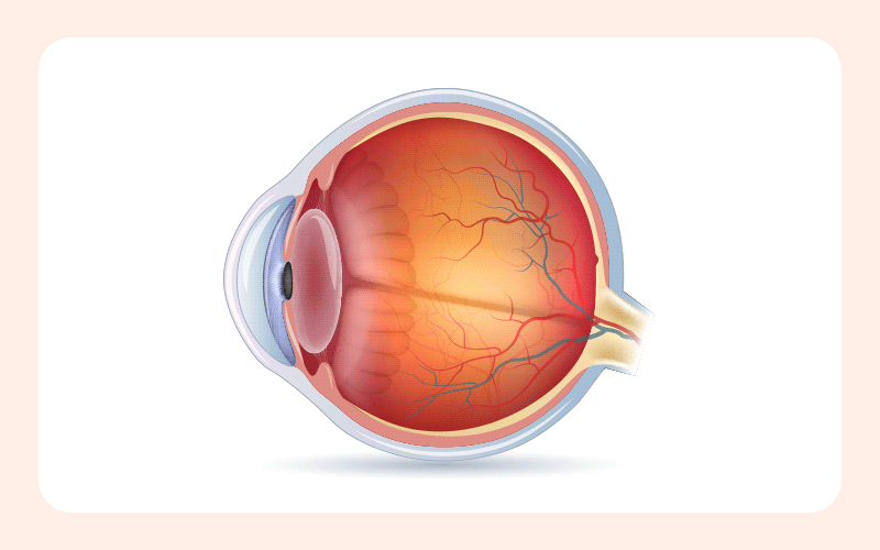 A medical illustration visualizing how a mature cataract progresses to trigger secondary glaucoma