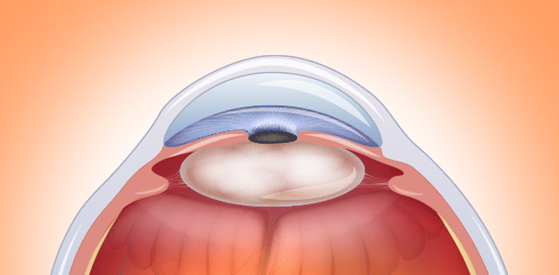 An illustration depicting the risk of surrounding tissue damage from high-energy ultrasound used to remove a hardened, mature cataract lens