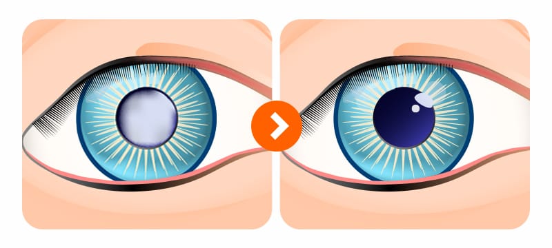 An illustration showing YAG laser treatment applied to a pupil with posterior capsular opacity (PCO), restoring it to normal