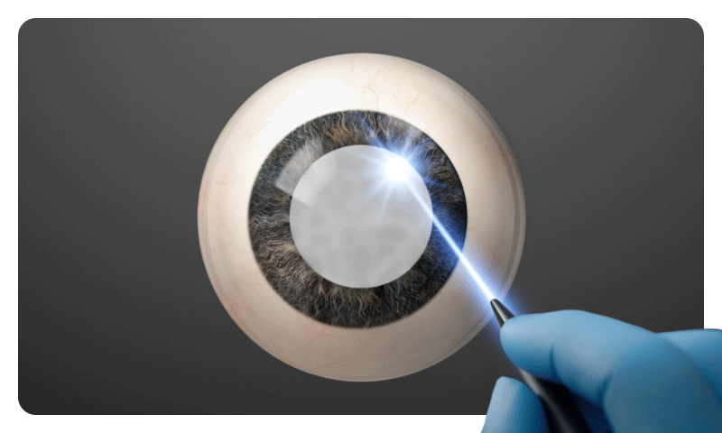 An illustration of a cloudy lens being fragmented with a laser