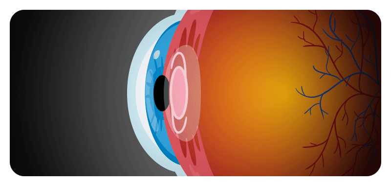 An illustration showing the capsular bag surrounding the intraocular lens becoming cloudy
