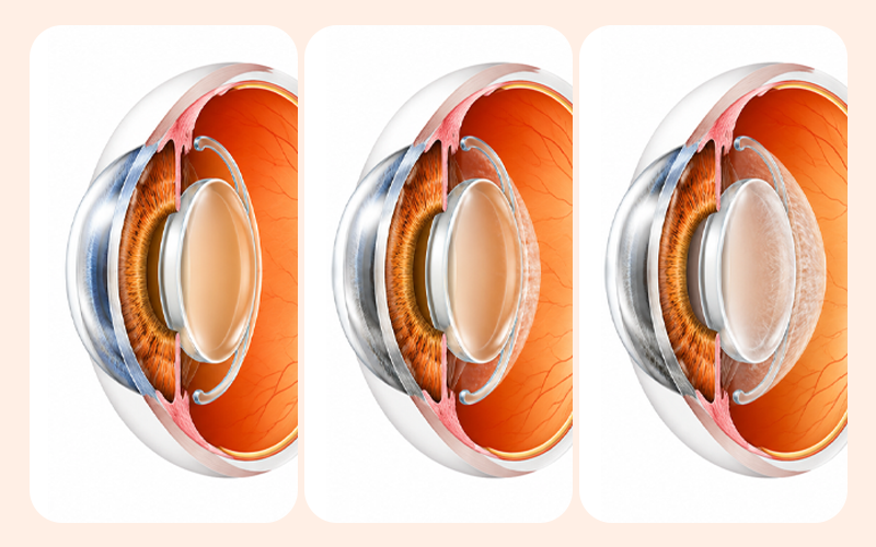 A medical illustration showing the posterior capsule surrounding the intraocular lens (IOL) gradually becoming cloudy