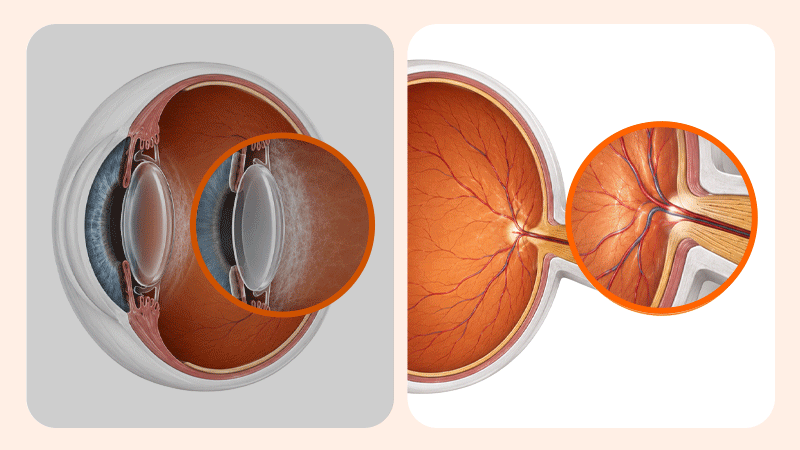 A medical illustration comparing posterior capsular opacity (PCO) with retinal issues