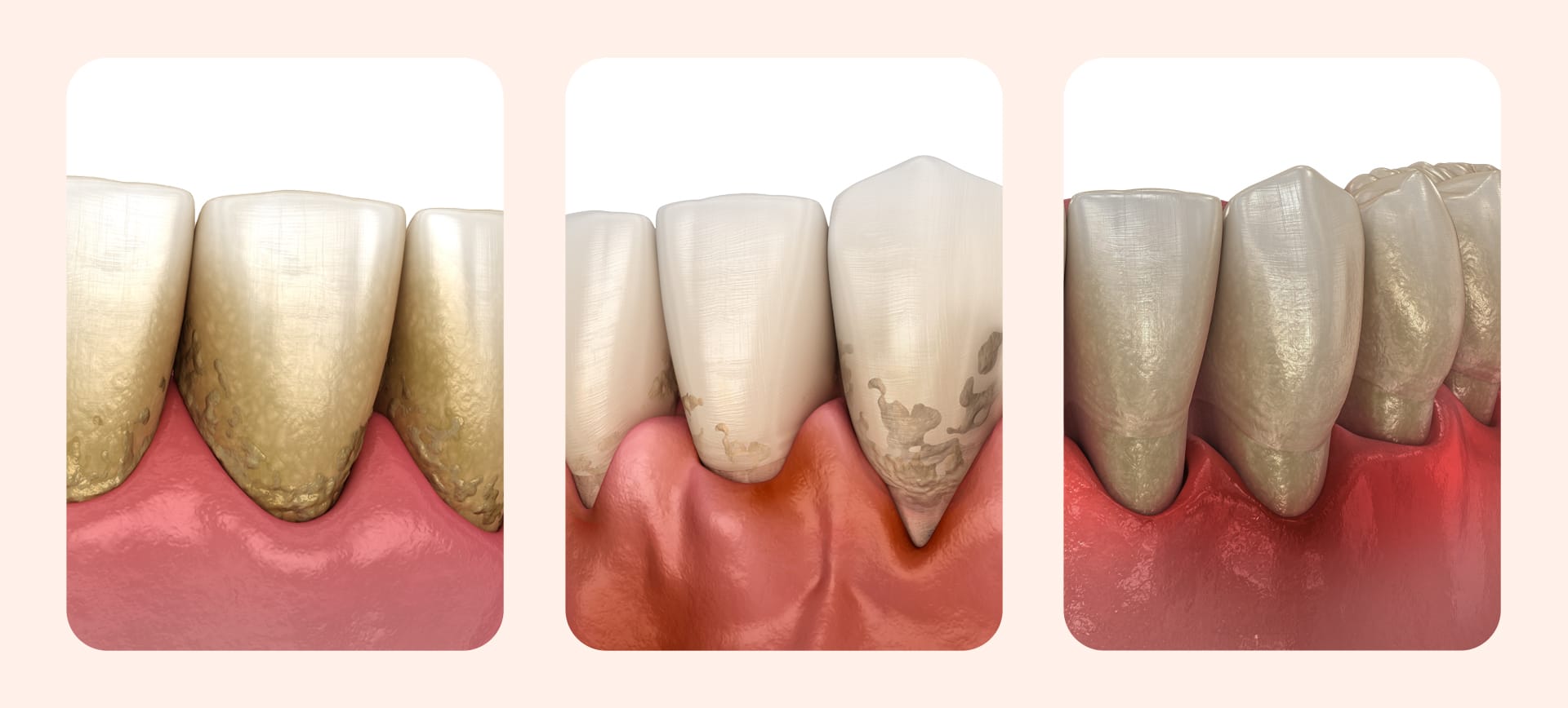 An image illustrating the states of gingivitis, periodontitis, and periodontal disease