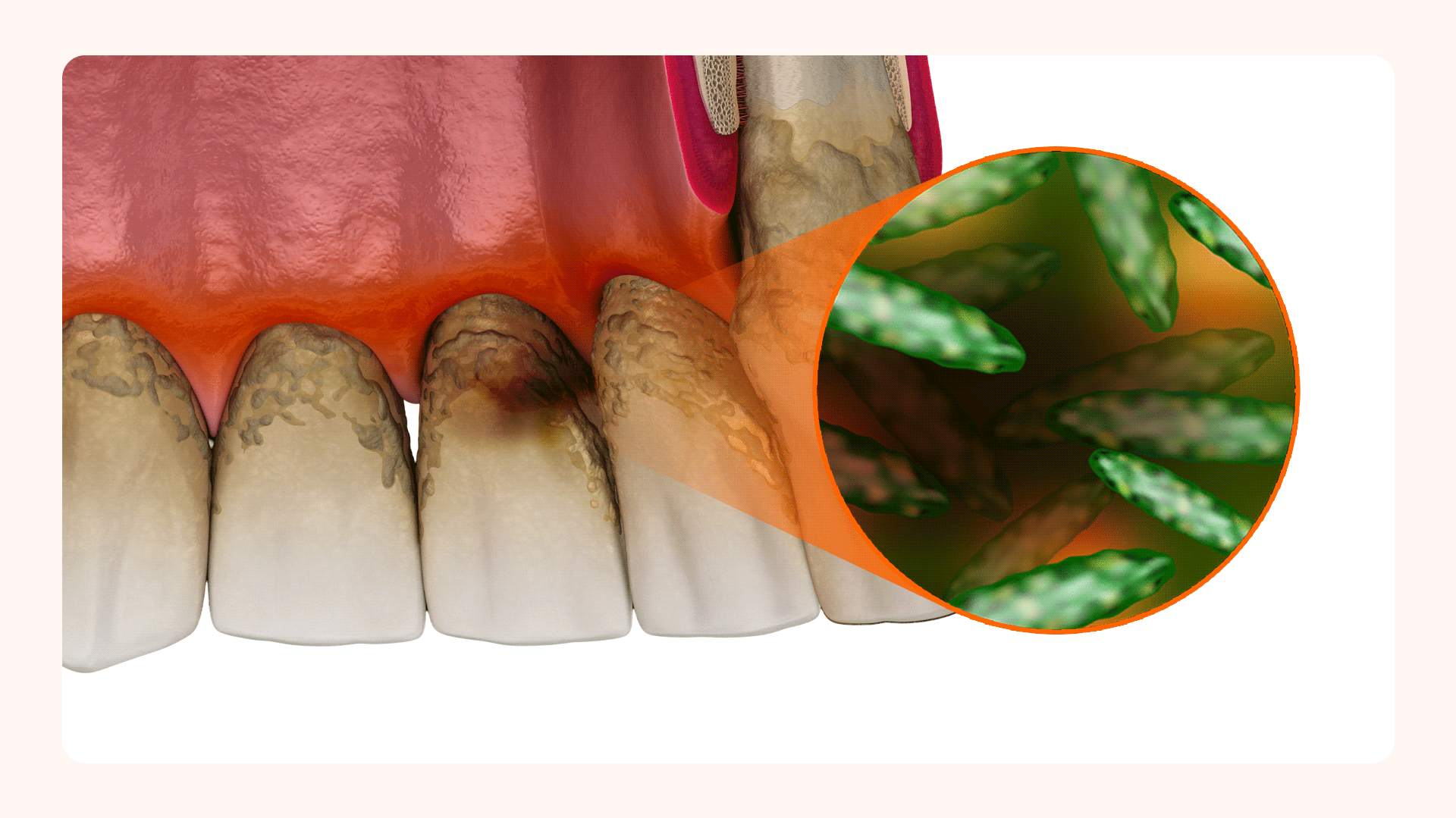 An image showing bacterial growth around the gums due to periodontal disease