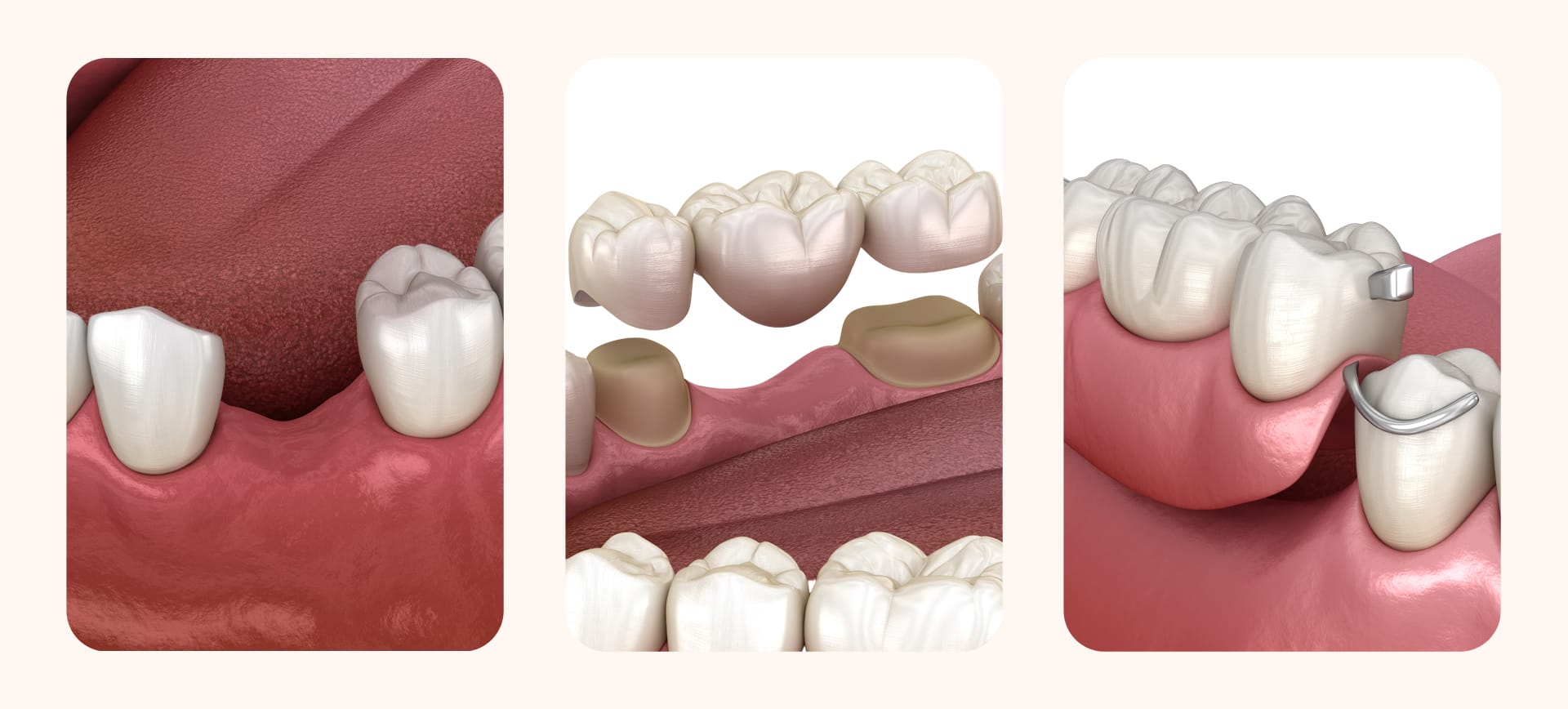 An image explaining situations where a dental implant is necessary