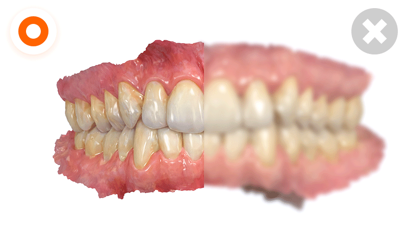 An infographic showing how oral scans can be inaccurate when inflammation, bleeding, or swelling is present