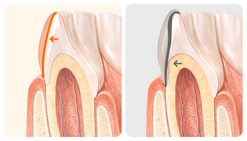 An illustration visualizing why enamel preservation is crucial for veneer bonding longevity